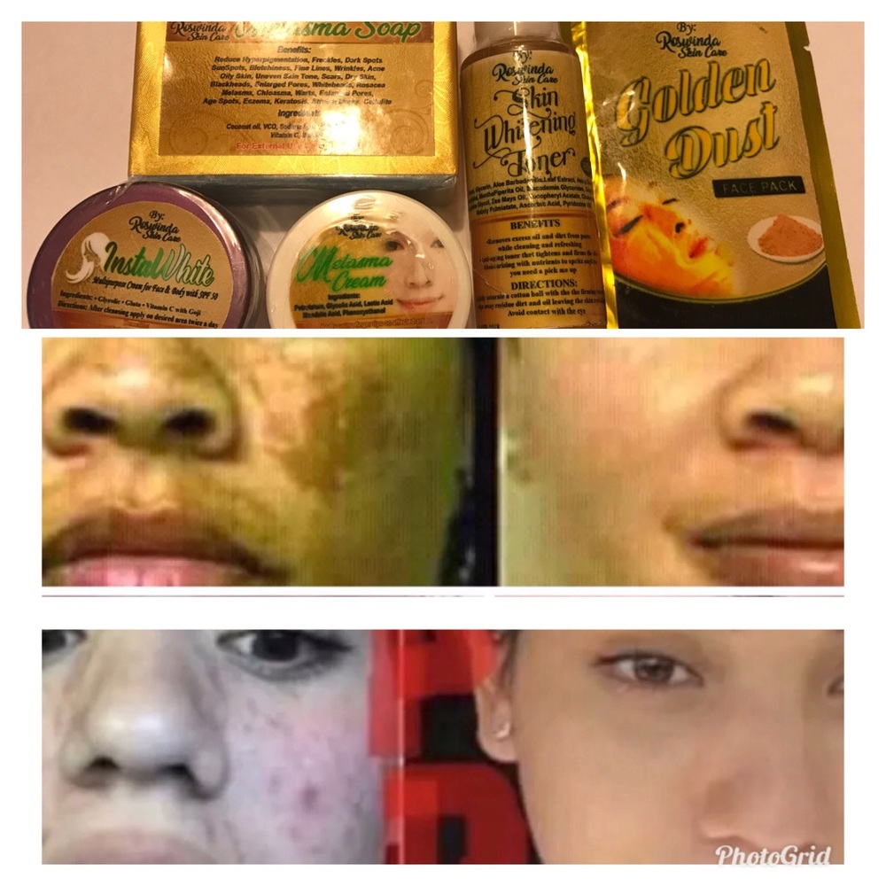 Melasma Set W/ 24k Gold Mask 100% Effective